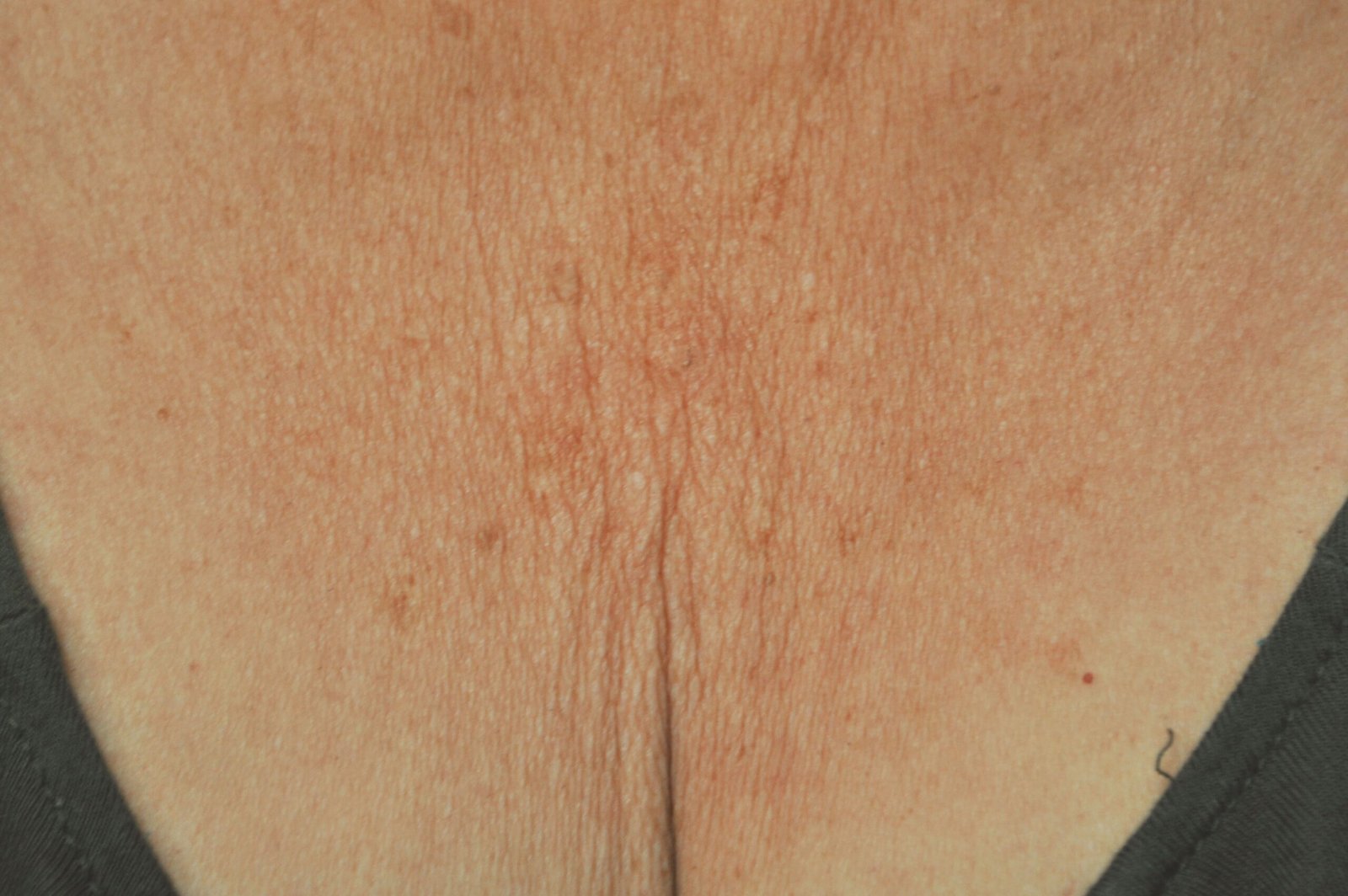 exilis before and after (1)