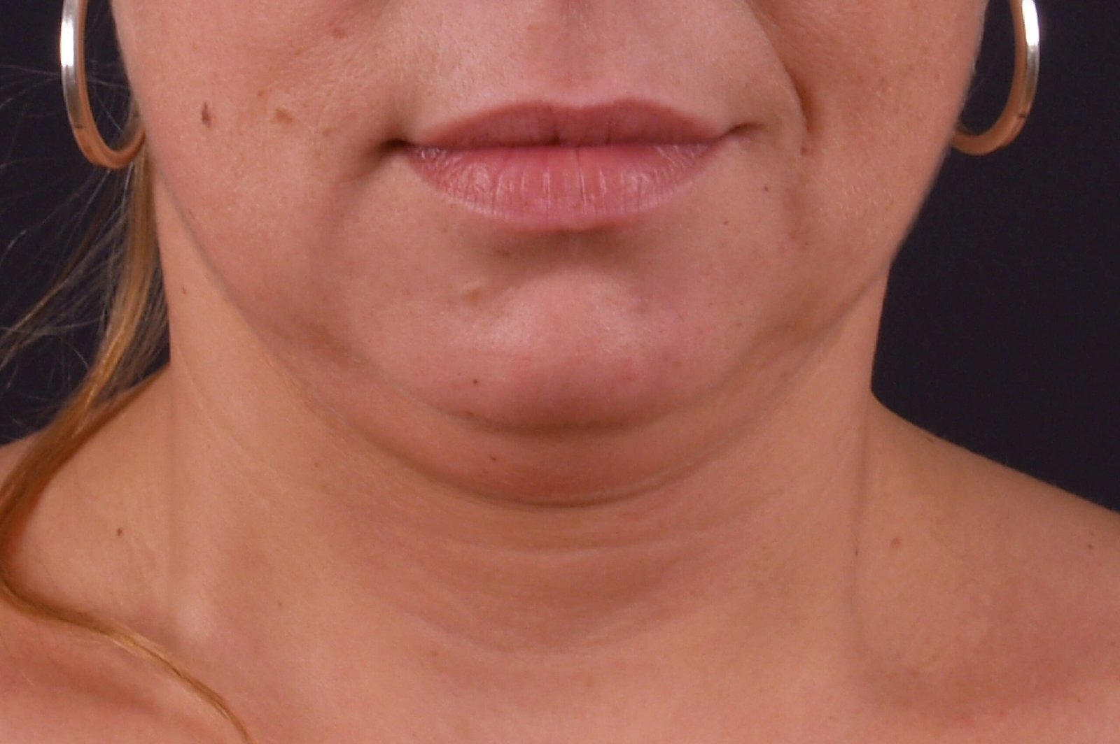 exilis before and after (11)