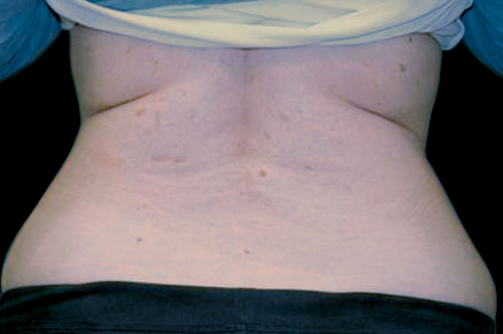 exilis before and after (12)