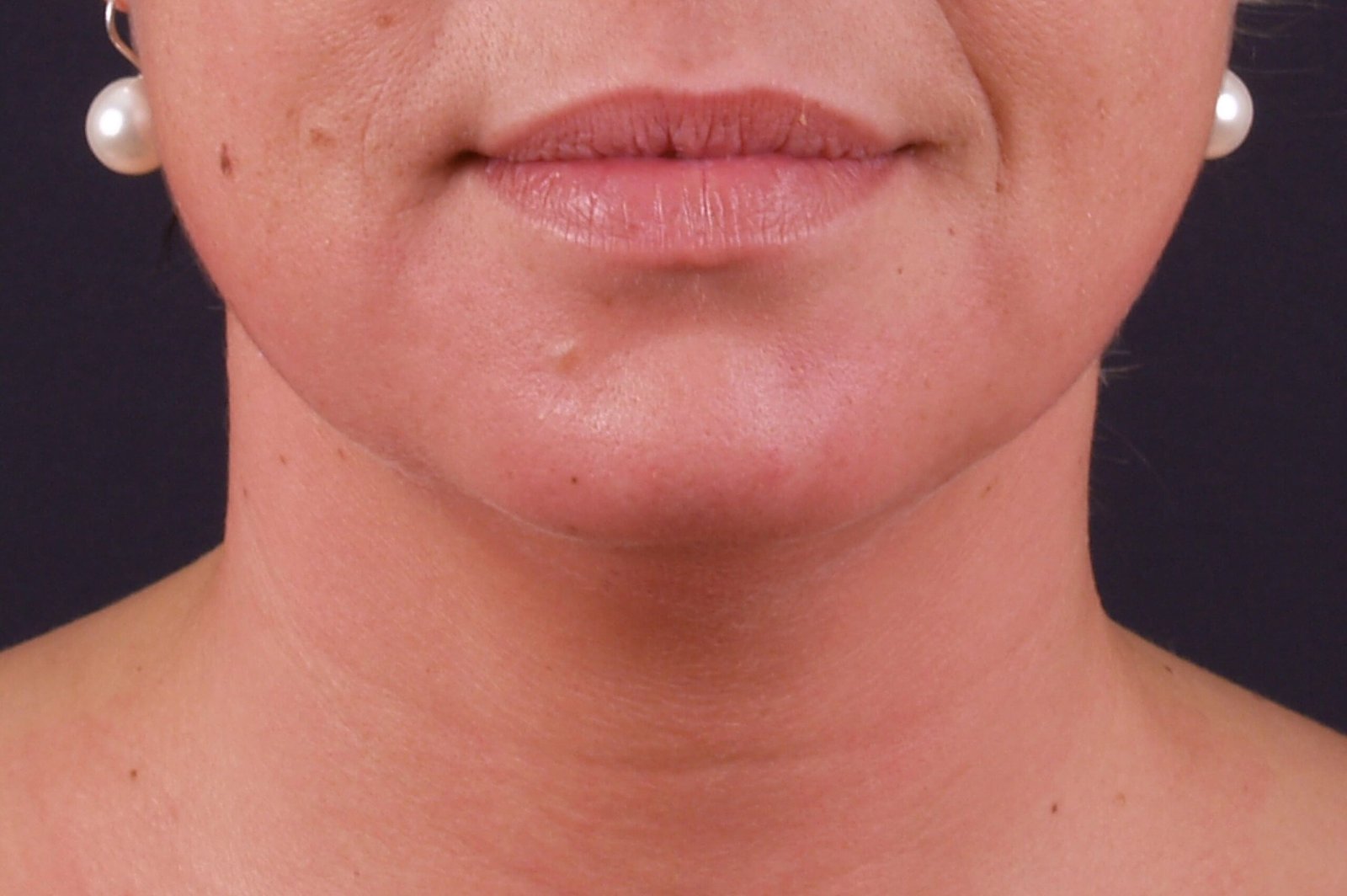 exilis before and after (4)