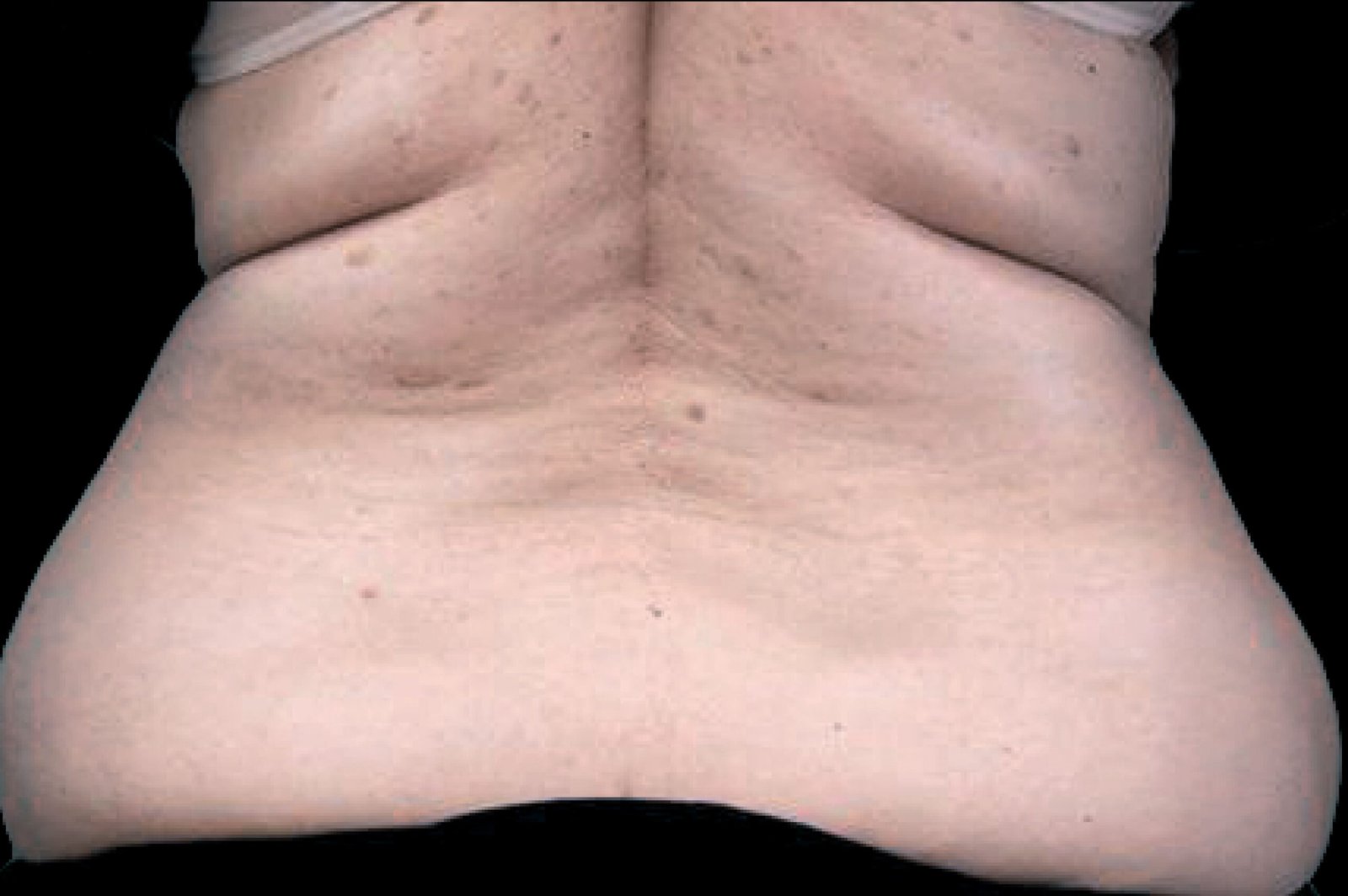 exilis before and after (9)