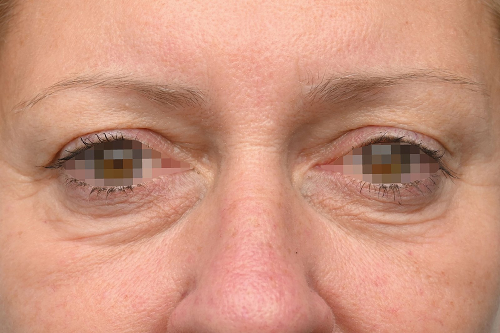 emface-eyes-before-and-after 3