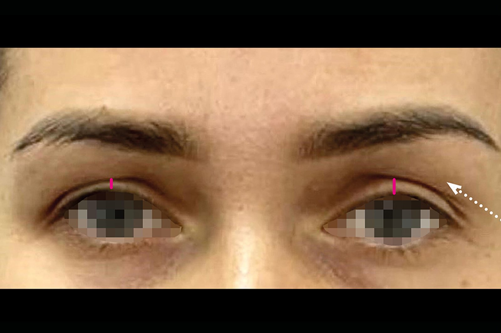 emface-eyes-before-and-after 9